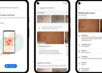Google AI tool can help patients identify skin conditions
