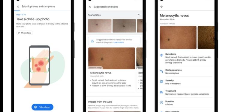 Google AI tool can help patients identify skin conditions