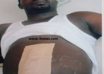 Bullet stuck in a man's abdomen for four years yet to be removed