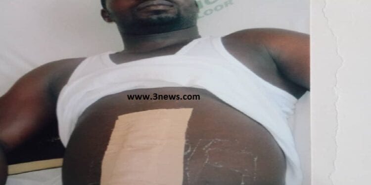 Bullet stuck in a man's abdomen for four years yet to be removed