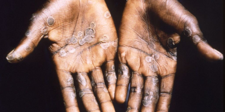Suspected monkeypox probed in Morocco and Sudan