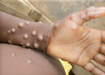 Number of cases of monkeypox has risen to 18 – Ghana Health Service