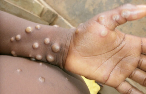 Number of cases of monkeypox has risen to 18 – Ghana Health Service