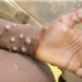 5 cases of monkeypox confirmed in Ghana