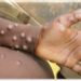 public-urged-to-stay-safe-against-the-monkeypox-virus