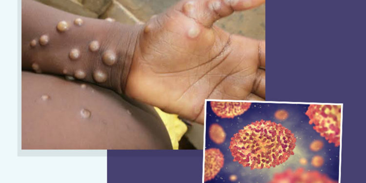 There should be more public education on Monkey pox as Ghana starts to record cases– Medical Officer