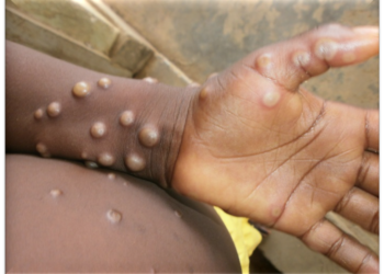 Ghana records first Monkeypox death