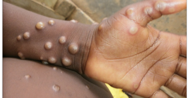 Ghana records first Monkeypox death
