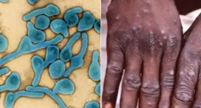 Tanzania detects its first-ever cases of the highly fatal Marburg viral disease