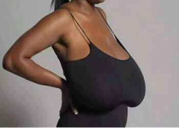 Check out what causes sagging of breast among women