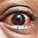 Conjunctivitis outbreak hits coastal Kenya