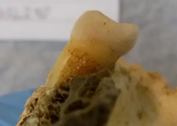 Tooth decay bacteria found in 4,000-year-old molars