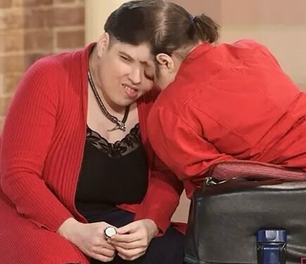 Oldest living conjoined twins and oldest female conjoined twins dead