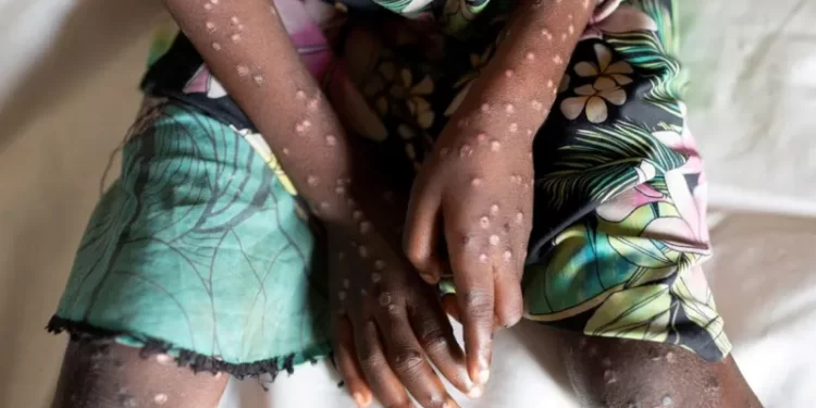 Central African Republic latest to declare mpox outbreak