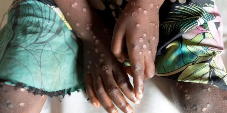 Mpox declared public health emergency in Africa
