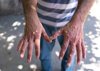 Ghana has no Mpox disease case in 2024 - Director of Public Health
