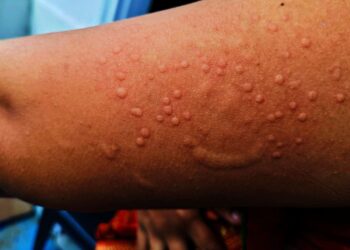 In response to a recent Mpox outbreak affecting 15 African countries, the Ghana Health Service (GHS) has intensified its surveillance measures to mitigate the risk of exposure in Ghana.