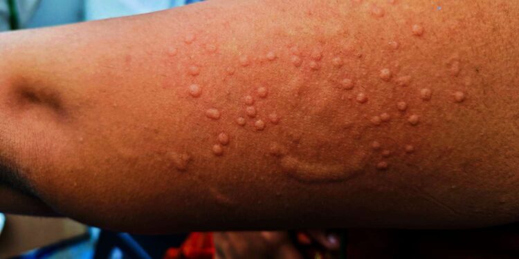 In response to a recent Mpox outbreak affecting 15 African countries, the Ghana Health Service (GHS) has intensified its surveillance measures to mitigate the risk of exposure in Ghana.