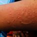 In response to a recent Mpox outbreak affecting 15 African countries, the Ghana Health Service (GHS) has intensified its surveillance measures to mitigate the risk of exposure in Ghana.
