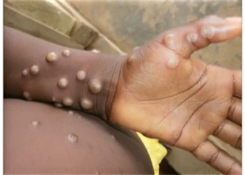 Western North records 1st Monkeypox Case; 230 Suspected Cases across 88 Districts in Ghana