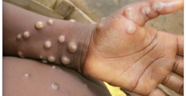 Western North records 1st Monkeypox Case; 230 Suspected Cases across 88 Districts in Ghana