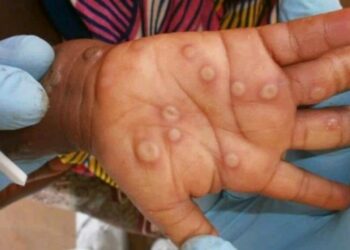 Ghana has confirmed 79 cases of Mpox (formerly known as Monkeypox) across the country in 2025, with no fatalities reported so far, according to the latest update from the Ghana Health Service.