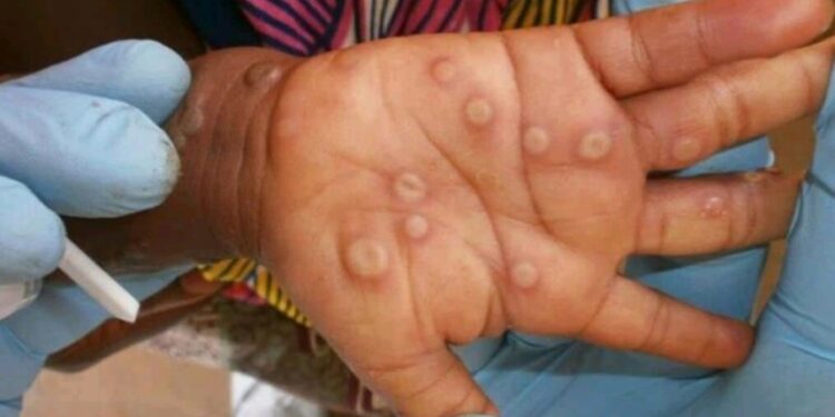 Ghana has confirmed 79 cases of Mpox (formerly known as Monkeypox) across the country in 2025, with no fatalities reported so far, according to the latest update from the Ghana Health Service.