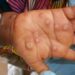 Ghana has confirmed 79 cases of Mpox (formerly known as Monkeypox) across the country in 2025, with no fatalities reported so far, according to the latest update from the Ghana Health Service.