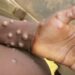 GHS Intensifies Public Education and Surveillance on Monkeypox