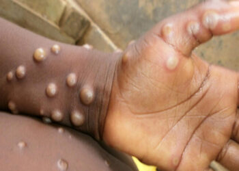GHS ramps up Mpox education after first recorded death