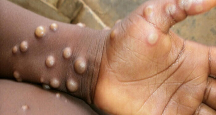 GHS ramps up Mpox education after first recorded death