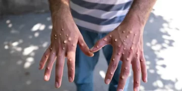 Mpox Surge in Ghana: 1,038 Cases and Eight Deaths