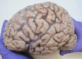 Only 16 Neurologists and 2 Public MRI Machines Serving Millions in Ghana – Expert Reveals